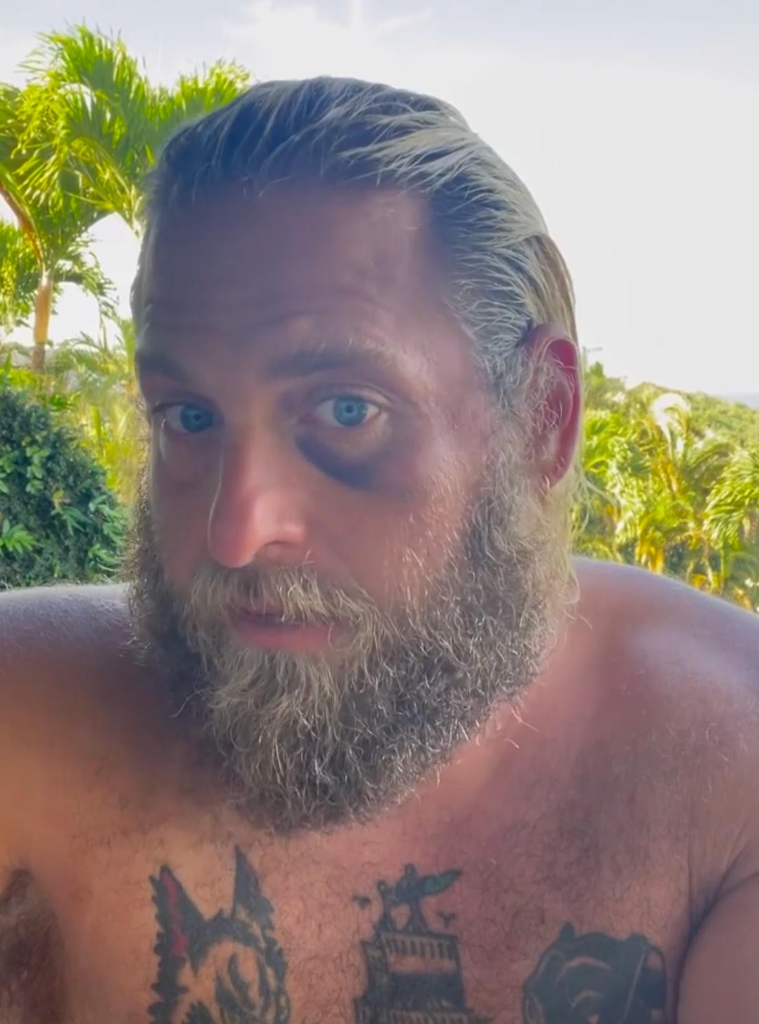 Jonah Hill Flaunts Massive Black-Eye Caused By A Surf Board Accident!