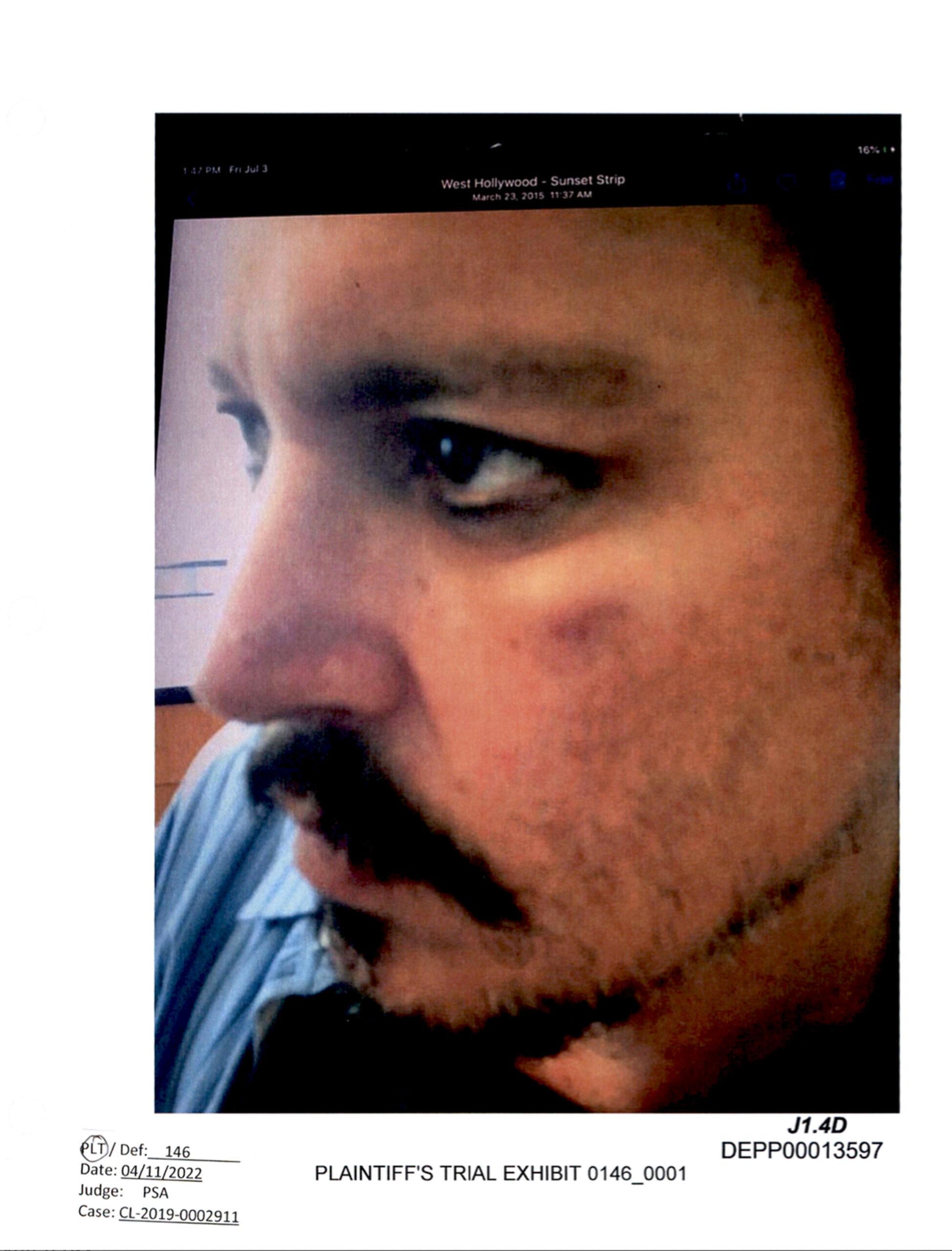 Johnny Depp appears to have bruising to his face in photos submitted as evidence in his defamation trial against ex-wife Amber Heard
