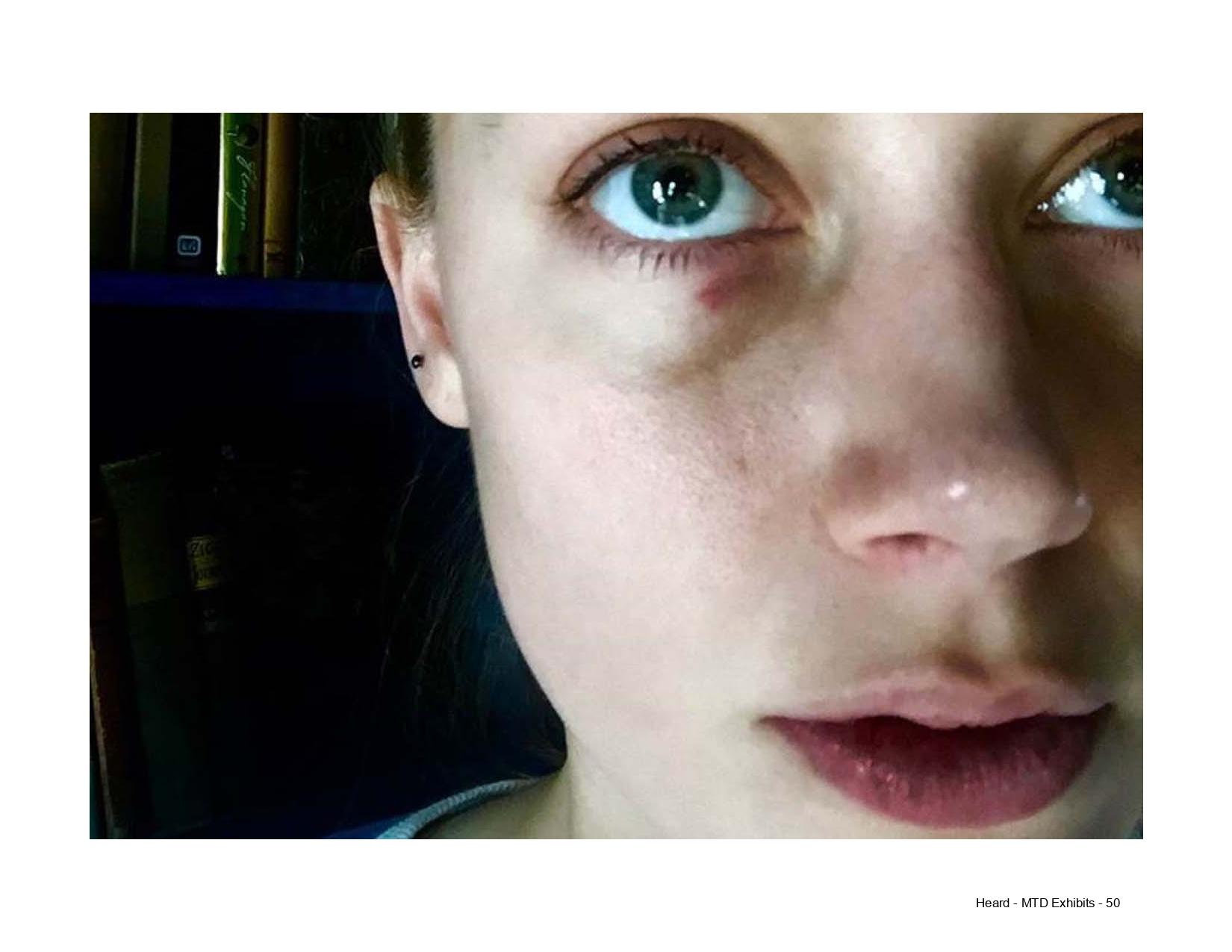 Amber Heard with facial bruises