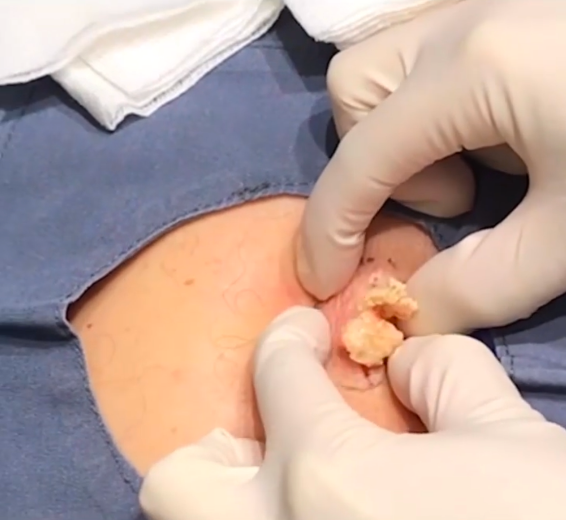 Dr. Pimple Popper -- Massive Explosion Looks Like 'Ricotta Stuffed Shells'