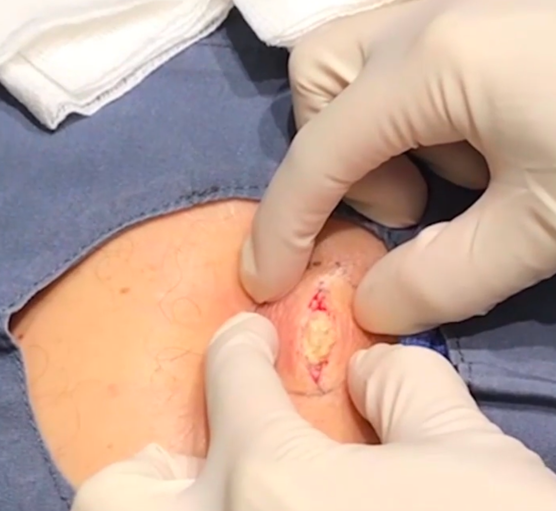 Dr. Pimple Popper -- Massive Explosion Looks Like 'Ricotta Stuffed Shells'