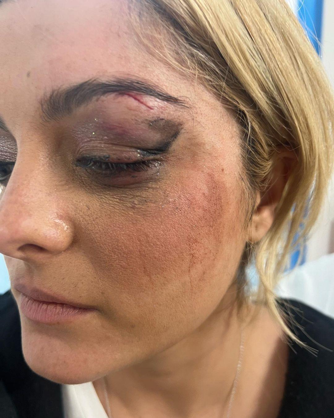 Bebe Rexha posts pictures of injury, telling fans: 'I'm good'