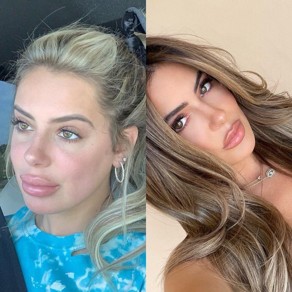 Brielle Biermann gets candid about lip fillers