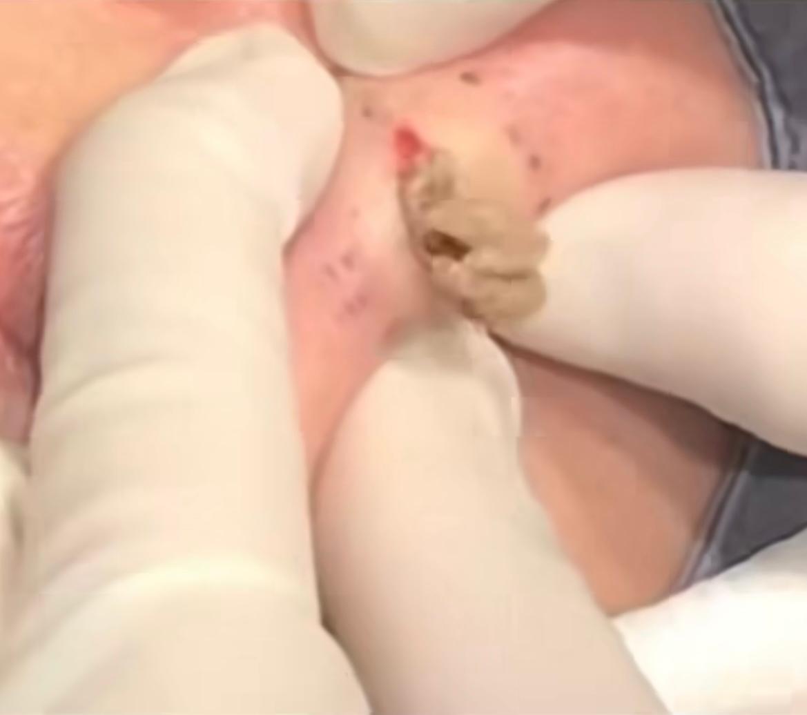 Dr Pimple Popper — Hard Acne Pops Out Of A Face Like Rotten Avocado
