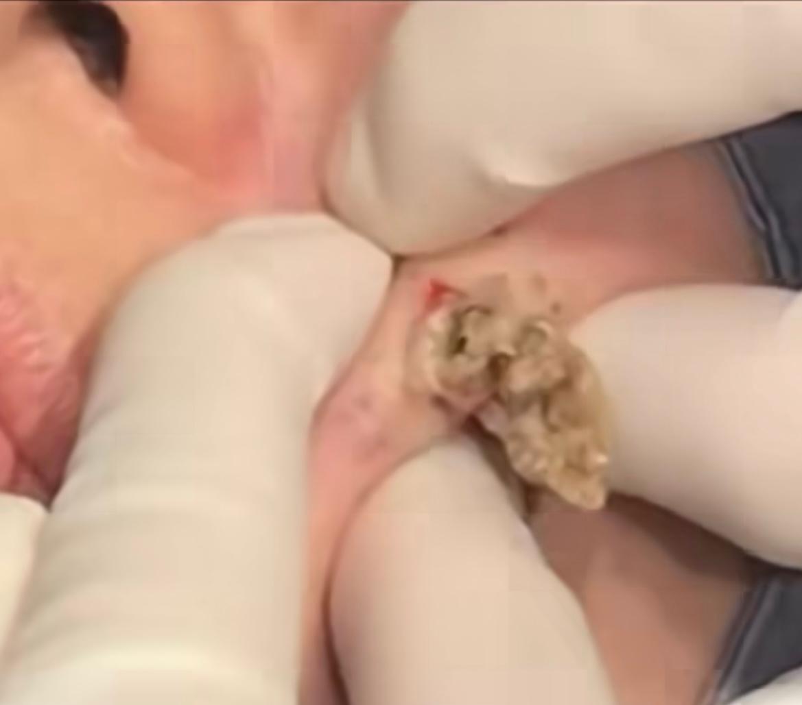 Dr Pimple Popper — Hard Acne Pops Out Of A Face Like Rotten Avocado