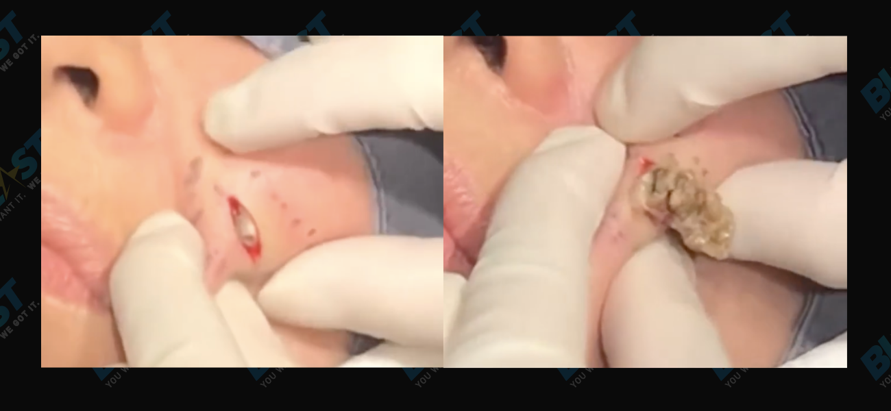 Dr. Pimple Popper: Hard Acne Pops Out Of Face Like Rotten Avocado