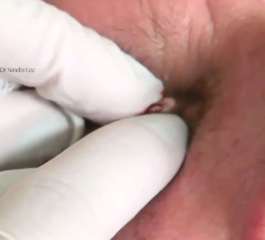 Dr Pimple Popper — Huge Blackhead Gives Patient A Literal Third Eye!