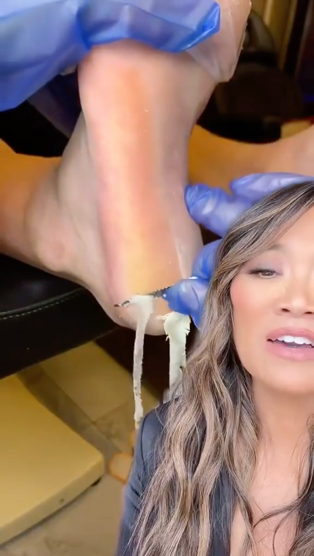 Dr Pimple Popper — See 'Parmesan Cheese' Noodles Being Scraped Off Feet