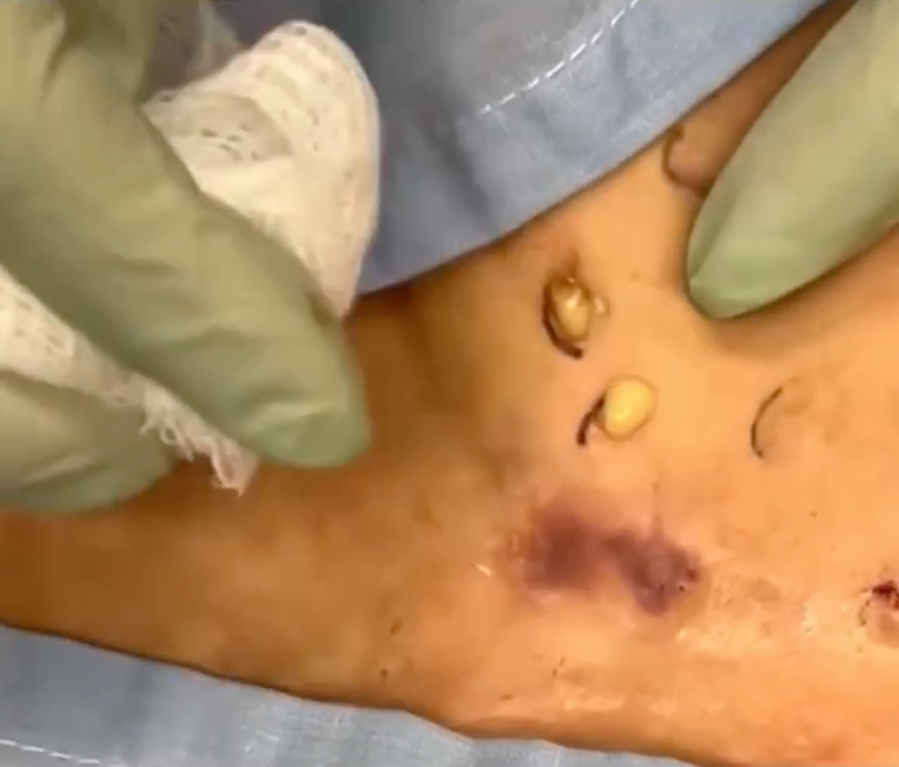 Dr Pimple Popper Butter cyst