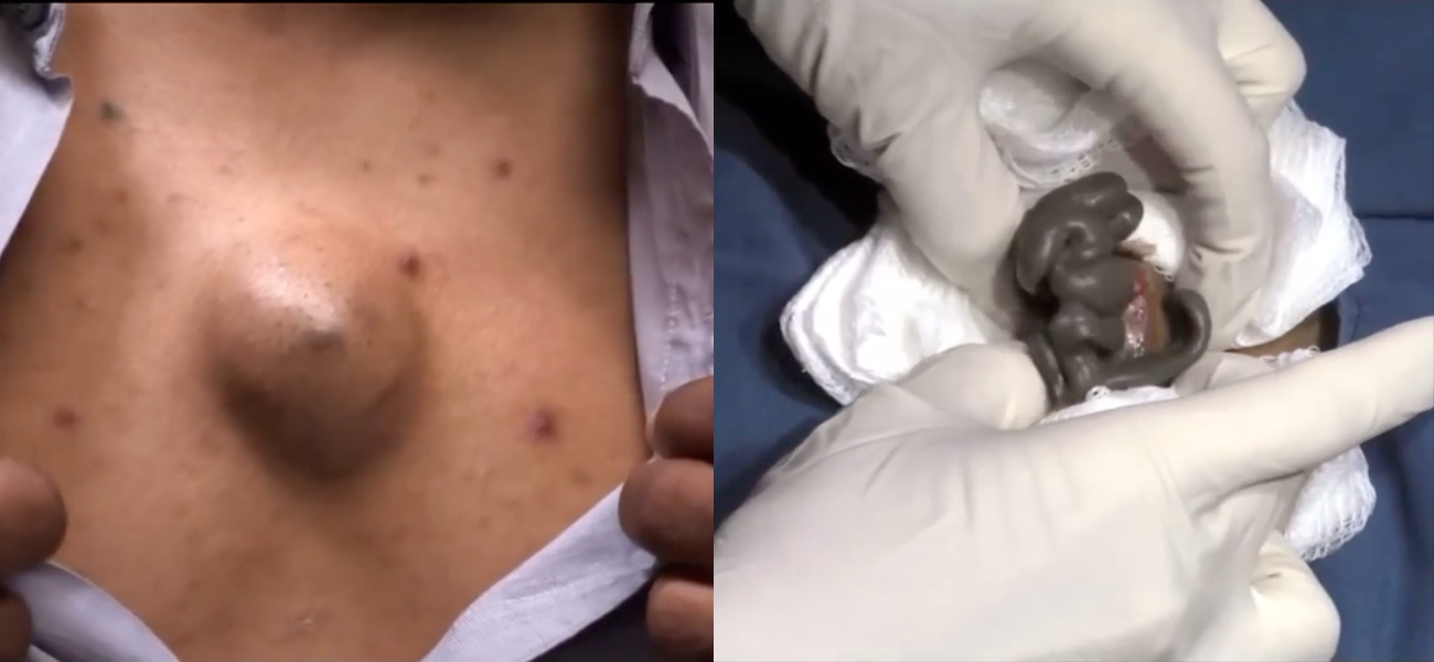 Dr Pimple Popper — Giant Chest Cyst Gushes ‘Chocolate Paste’ After Being Sliced