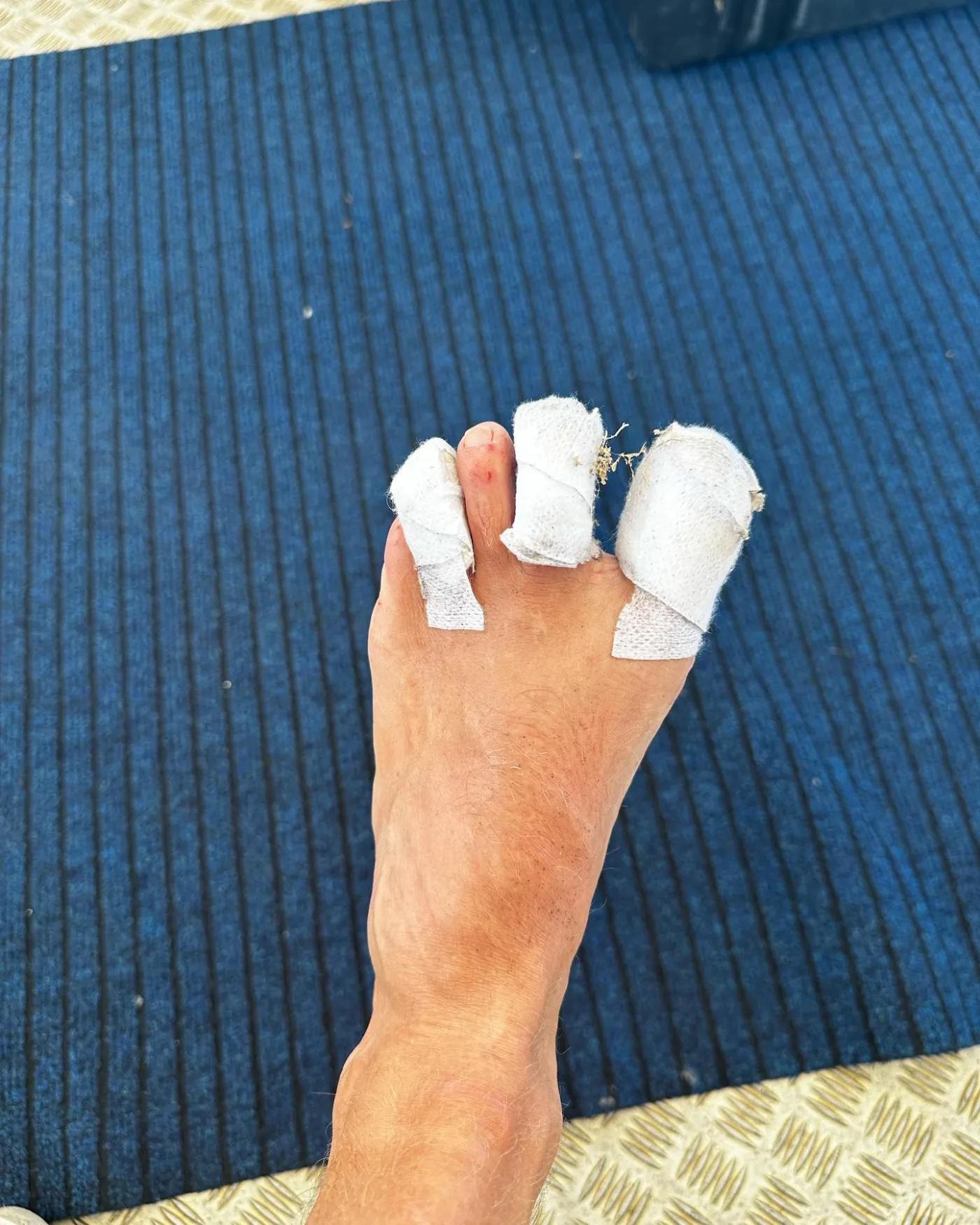 Colin Jost's foot taped up after ant attack