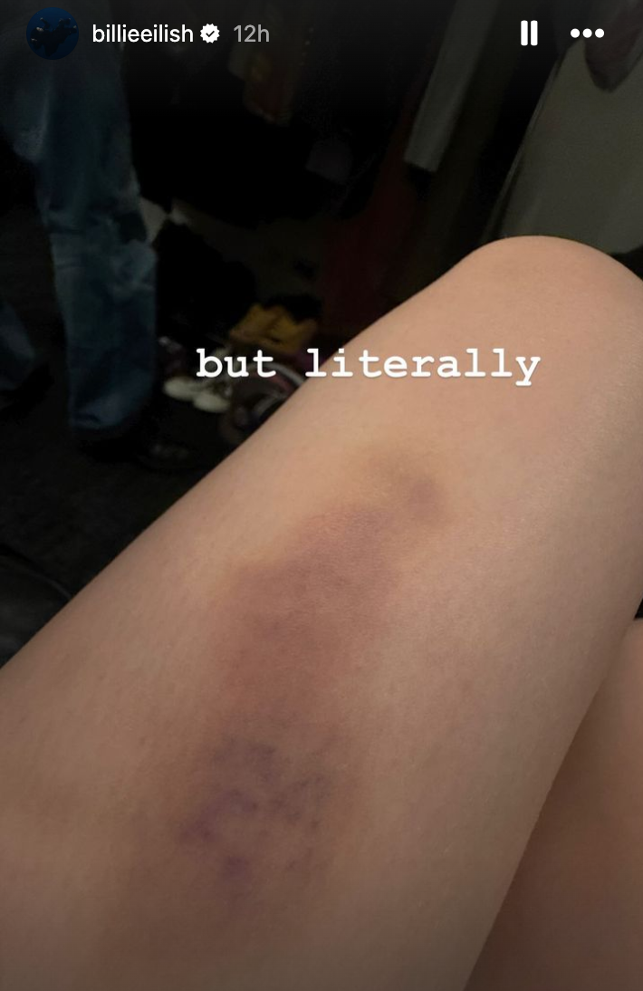 Billie Eilish left with massive bruise on leg