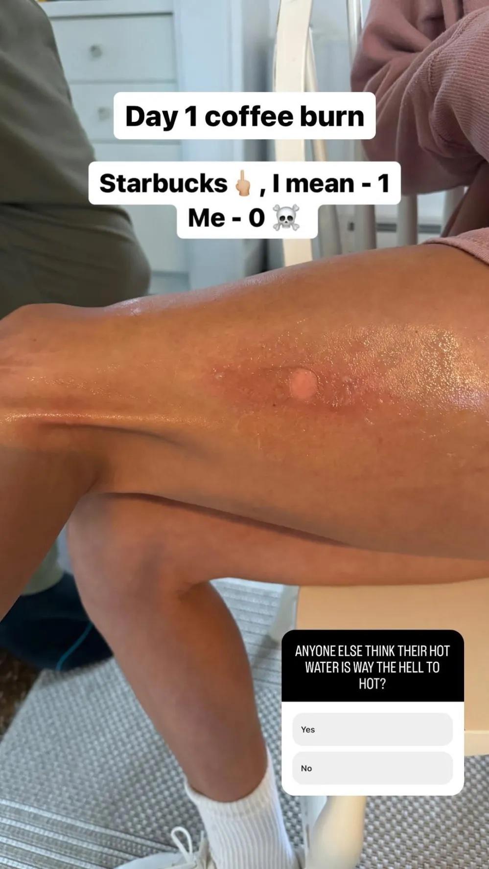 Danica Patrick shares photo of burn