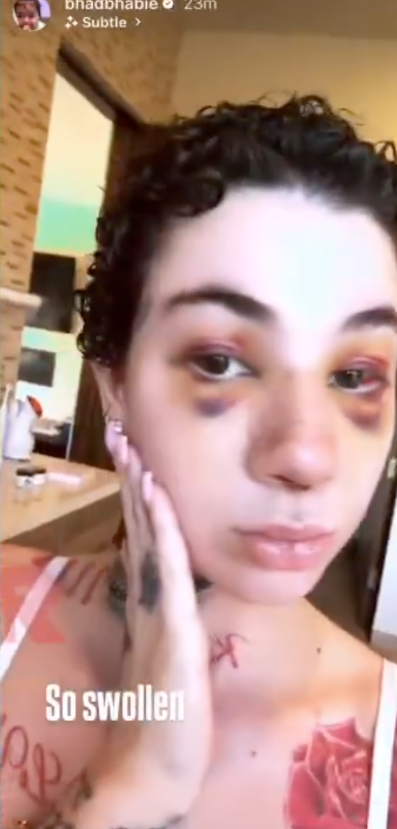 Bhad Bhabie shows off bruising from nose job