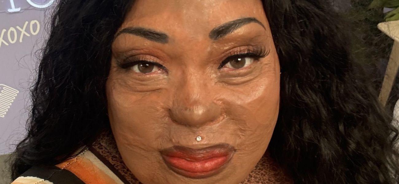 Burned Beauty: How Tonya Turned Trauma Into Advocacy After Surviving A Domestic Violence Attack