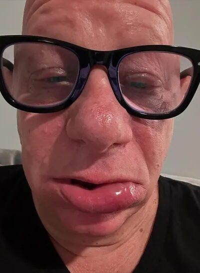 Jeff Ross shows off allergic reaction