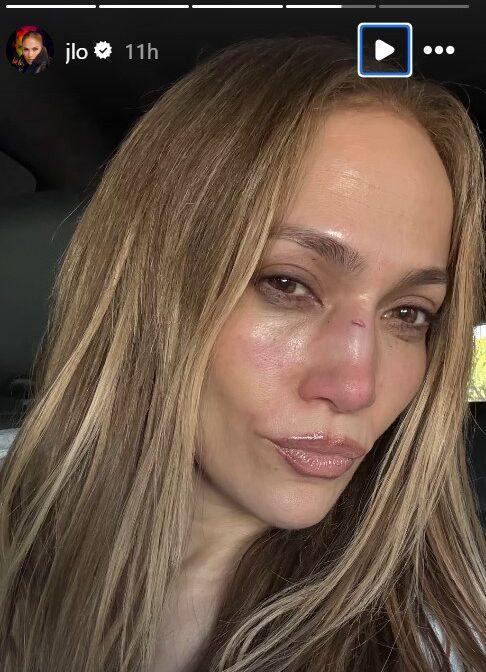 Jennifer Lopez shows injury on her face