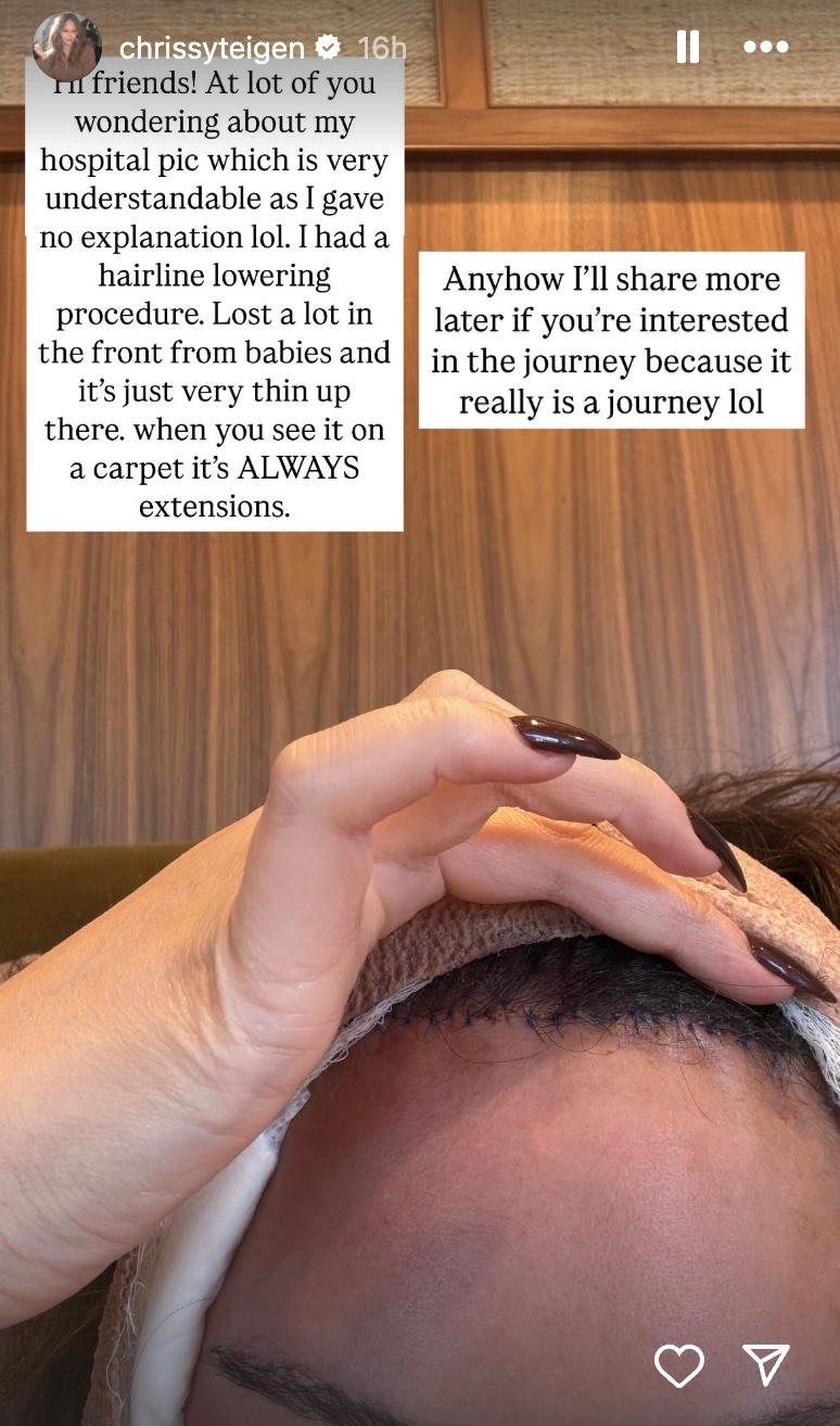 Chrissy Teigen hairline stitches