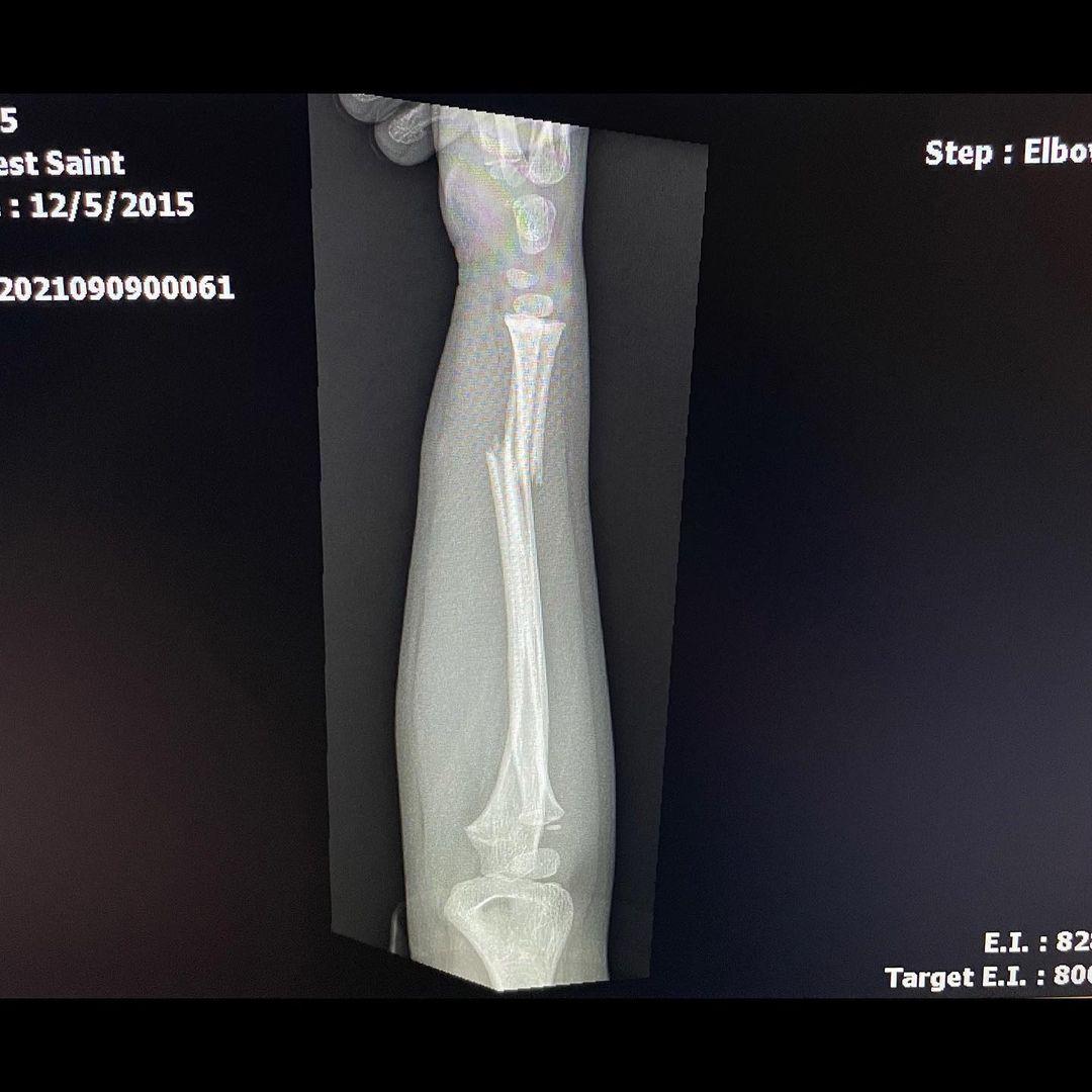 Kanye West Posts Brutal X-Ray Pictures Of Son Saint’s Broken Arm!