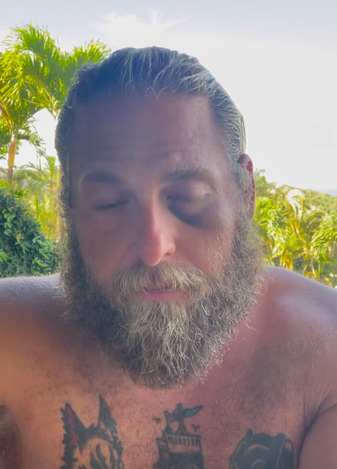 Jonah Hill Flaunts Massive Black-Eye Caused By A Surf Board Accident!