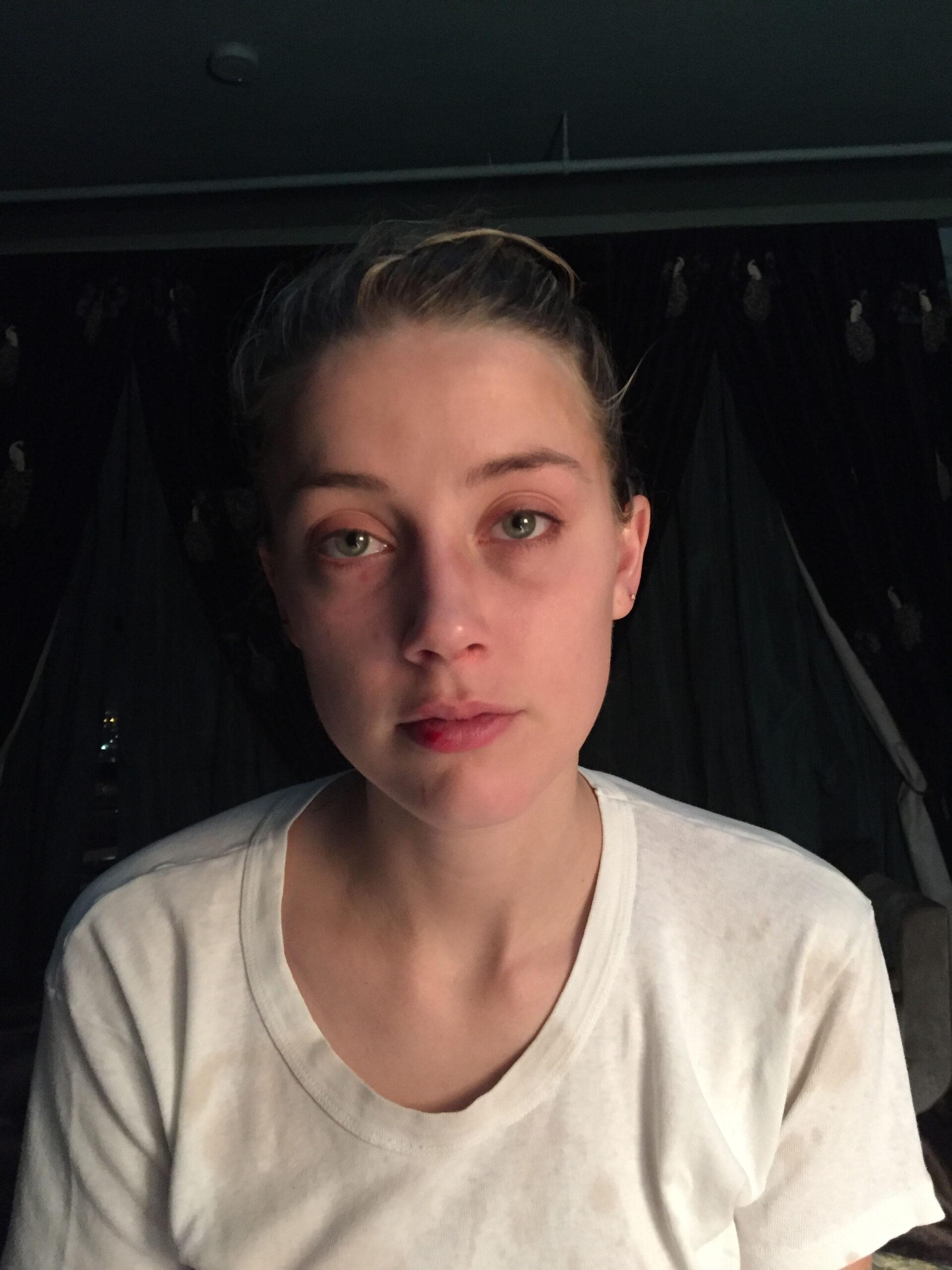 Amber Heard shows her bruised face and ripped scalp in disturbing photos taken after a 2015 fight where she claims Johnny Depp beat her so badly she thought she was going to die. The photos were shown in court as Heard gave evidence in the ex-couple’s defamation trial, claiming Depp headbutted her and dragged her by her hair, leaving chunks of it all over the floor. Heard told Fairfax County Circuit Court she suffered two black eyes and a split lip during a fight with Depp in December 2015. According to a report of the proceedings published by the Daily Mail, Heard said Depp asked her, “You really want to go now, tough guy?’ before punching her. Heard said: “I look him right in the eyes. It was a really still moment. “(He said) ‘You want to go again, tough guy?’ I looked right up at his face, he balled up his face, leaned back and headbutted me square in the nose. “Instantly (I felt) searing pain. It's one of the few memories I have of physical pain, searing pain.” She told the court Depp dragged her by the hair into a neighboring apartment, leaving chunks of hair all over the floor. Depp got on top of her with her face in a pill and was repeatedly beating her, the court heard. Heard said: 'He's trying to hold me with his knee on my back and he's punching me with a closed fist repeatedly. “I remember the sound of Johnny's voice he got next to my ear and he was screaming over and over again, ‘I f**king hate you! I f**king hate you!’ Over and over. ‘F**king hate you!’ Pounding the back of my head with his fist. “I could hear myself scream until I couldn't hear myself anymore, I could just hear him say he was going to kill me and he sounded like an animal in pain when he was saying he f**king hated me. “He sounded different, like he was in agony. He just hit me over and over and over again. I got really still and it felt in my body quiet. “I thought, ‘This is how I die, he's going to kill me now. He's going to kill me and he won't even have realized it.’ “I couldn't breathe. I remember trying to scream and I couldn't scream suffocating in this pillow top with him holding me down punching me. I don't have any memory after that until I woke up.” The former couple are facing each other at a trial at Fairfax County Circuit Court in Virginia as Depp sues for $50 million over a December 2018 op-ed Heard wrote for the Washington Post declaring herself a domestic violence survivor. The article did not mention Depp by name, but he claims he lost his iconic role of Captain Jack Sparrow in the Pirates of the Caribbean franchise because of the “clear implication” he was Heard’s abuser. 05 May 2022 Pictured: Amber Heard shows two black eyes and a split lip in photos taken after an alleged December 2015 fight with Johnny Depp, in which she claims he beat her so badly she thought she was going to die. The photos were submitted as defence exhibits in the ex-couple's defamation trial at Fairfax County Circuit Court. Photo credit: MEGA TheMegaAgency.com +1 888 505 6342 (Mega Agency TagID: MEGA854687_008.jpg) [Photo via Mega Agency]