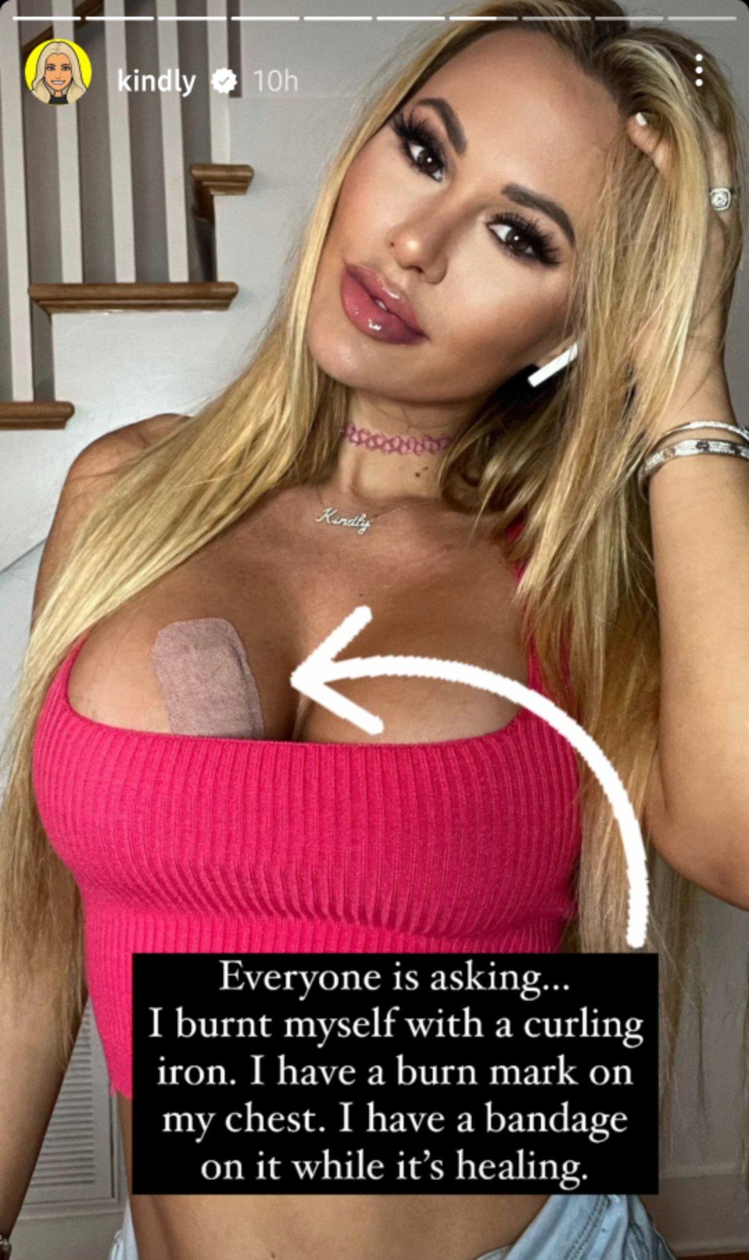 Kindly Myers accidently burns herself