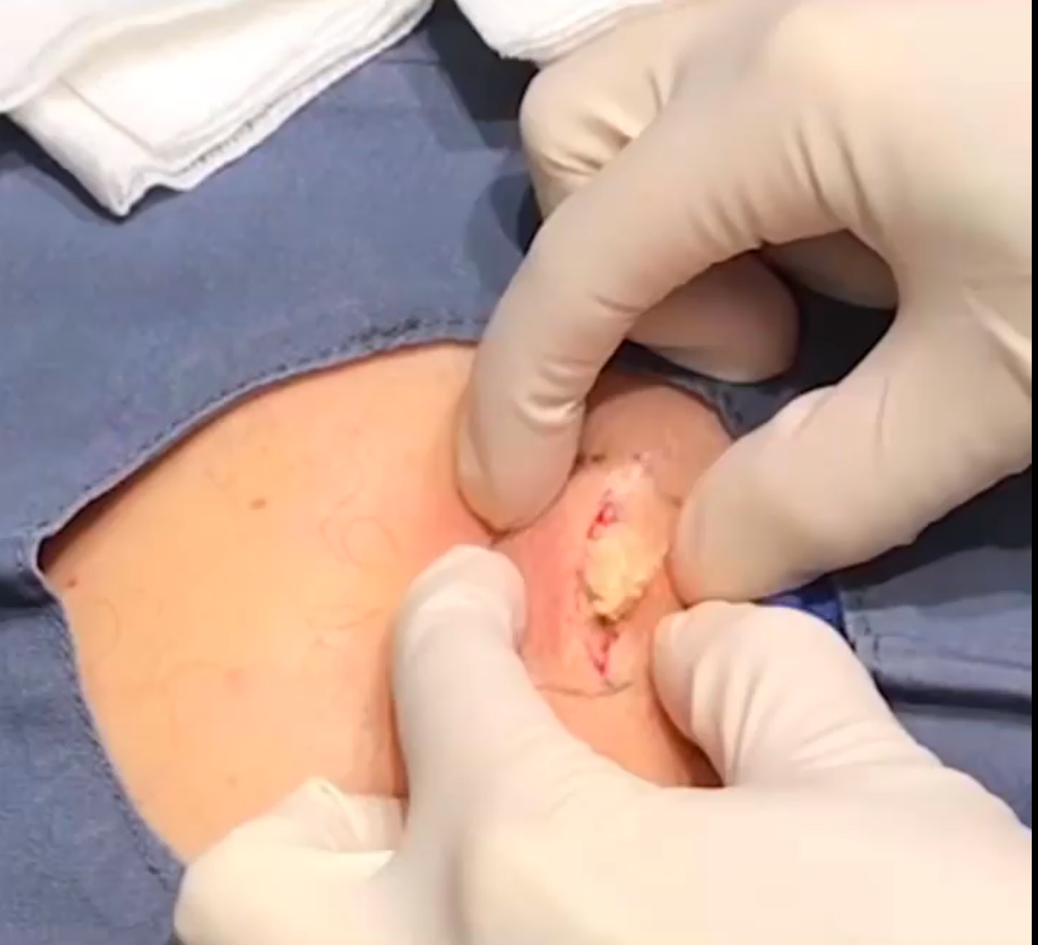 Dr. Pimple Popper -- Massive Explosion Looks Like 'Ricotta Stuffed Shells'