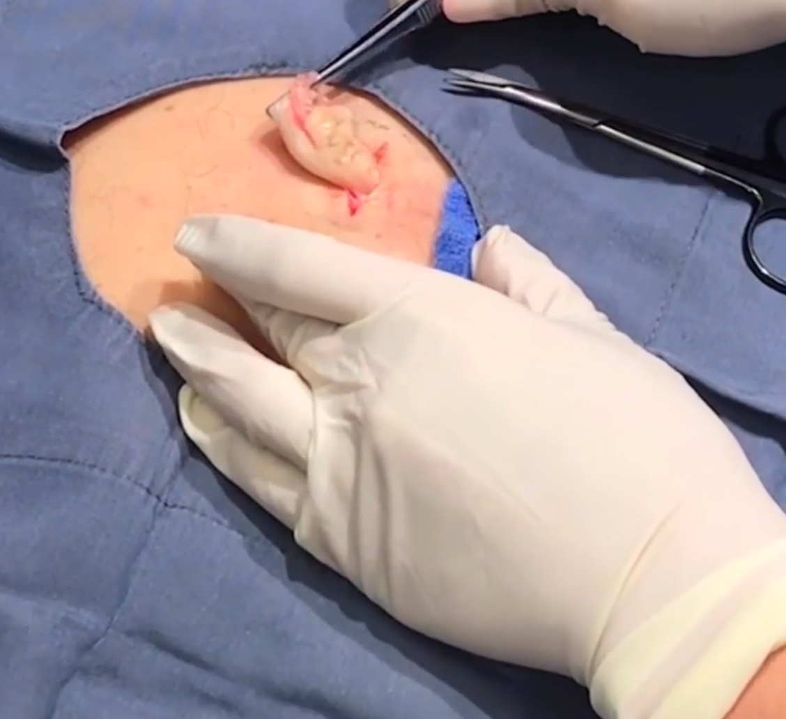 Dr. Pimple Popper -- Massive Explosion Looks Like 'Ricotta Stuffed Shells'