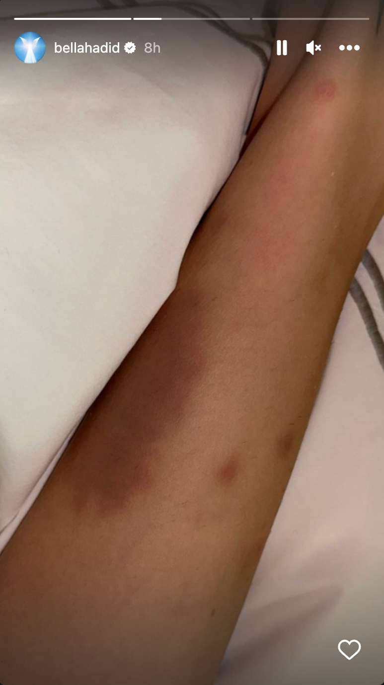 Has Bella Hadid's Lyme Disease Worsened? She Is Bruised And Battered In IG Story