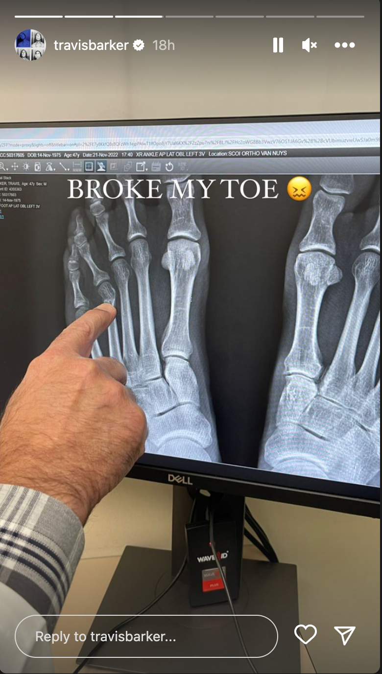 Travis Barker's Broken Toe Didn't Slow Down His Birthday Celebrations