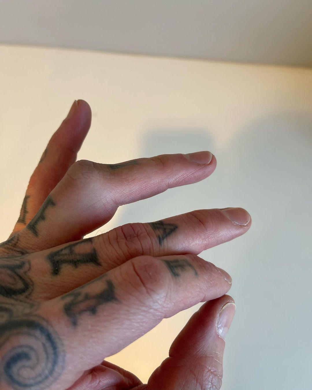 Travis Barker shows broken finger