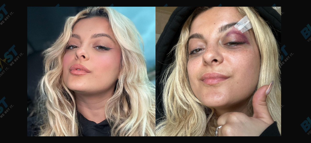 Bebe Rexha posts pictures of injury, telling fans: 'I'm good'