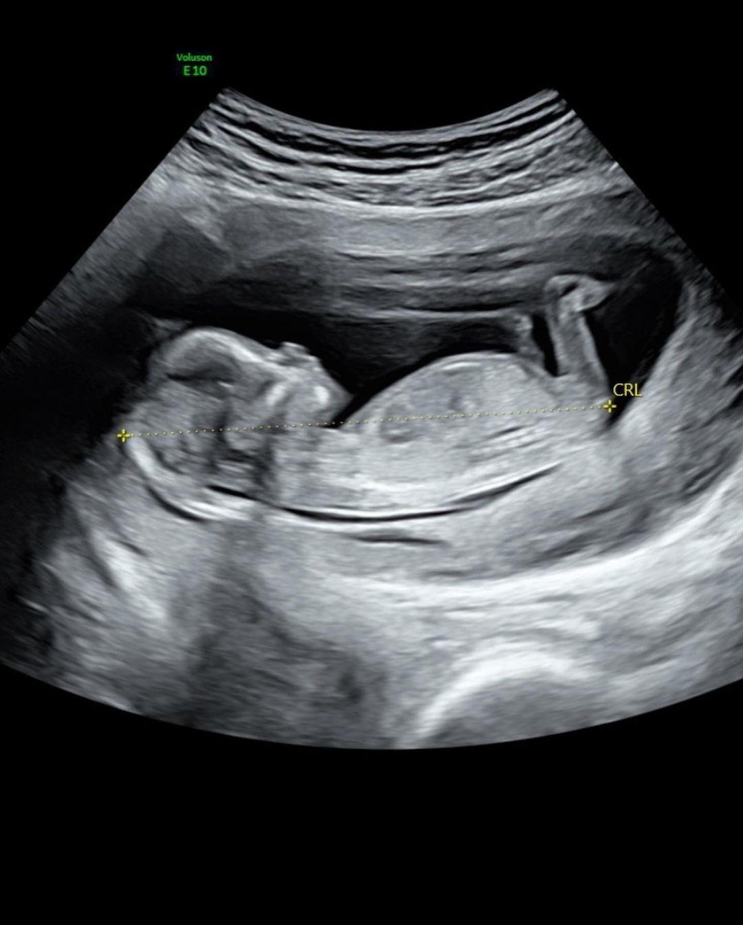 Natalie Joy's ultrasound