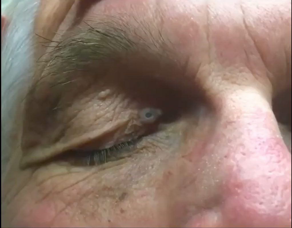Dr Pimple Popper — Huge Blackhead Gives Patient A Literal Third Eye!