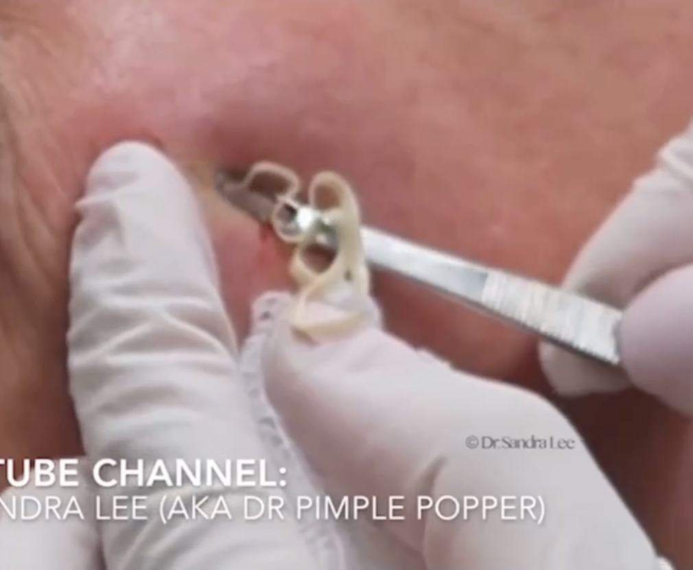 Dr Pimple Popper shows creamy explosion