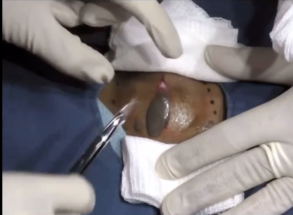 Dr Pimple Popper — Giant Chest Cyst Gushes 'Chocolate Paste' After Being Sliced
