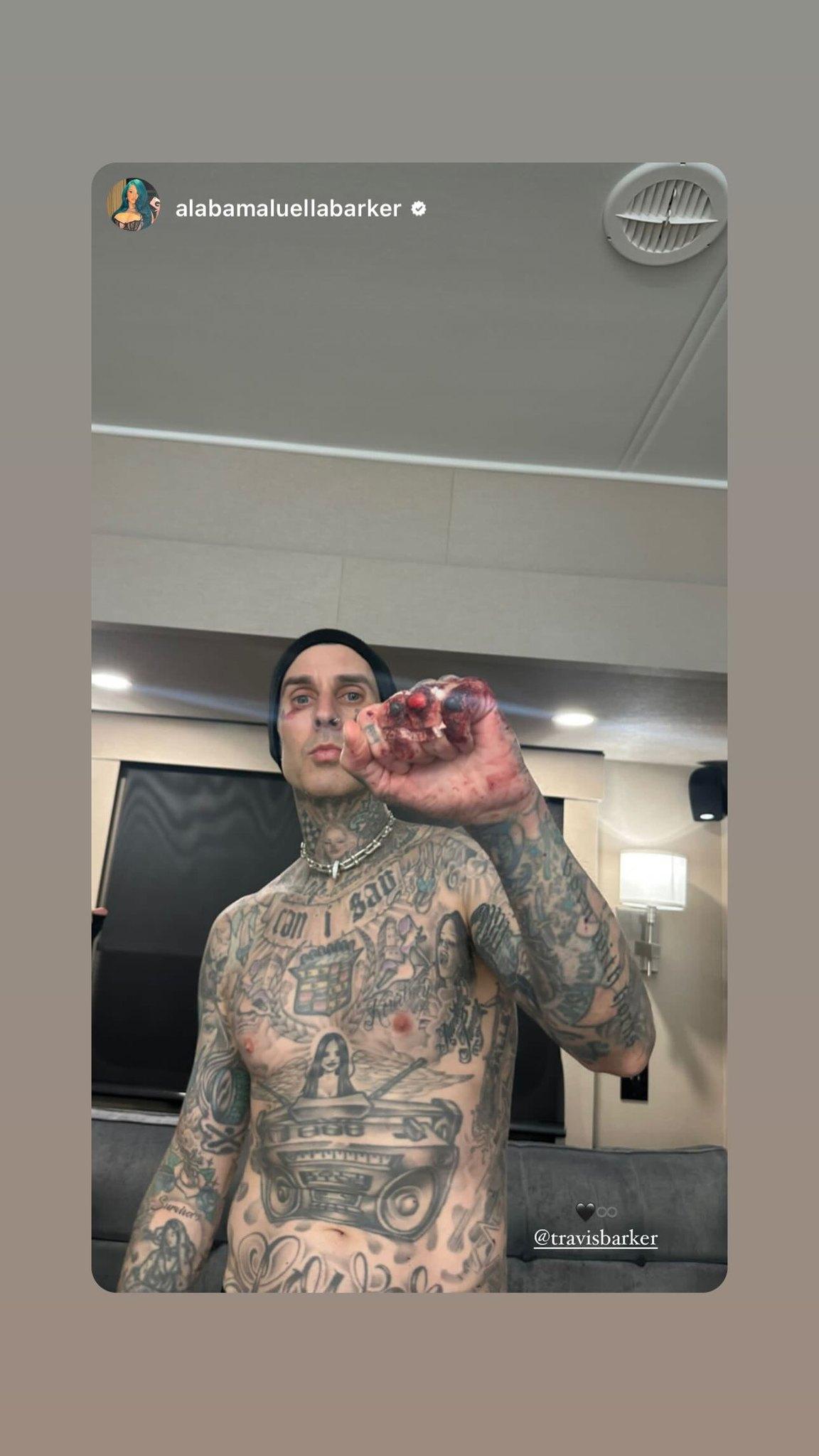Travis Barker Reveals Black Eye, Bloodied Knuckles In Gruesome New Pic