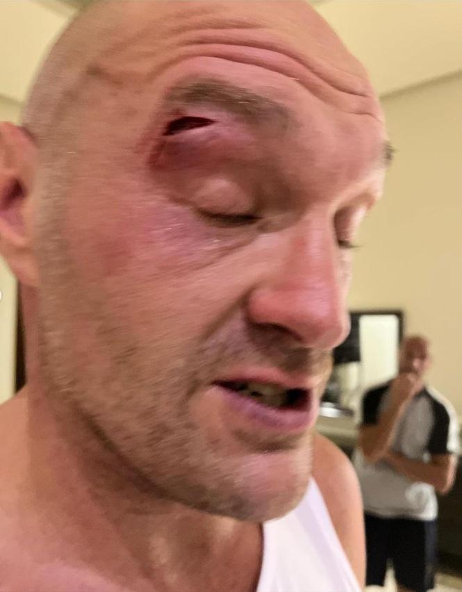 Tyson Fury Suffers Gruesome Cut, Leaves Wife 'Shaken' [PHOTO]