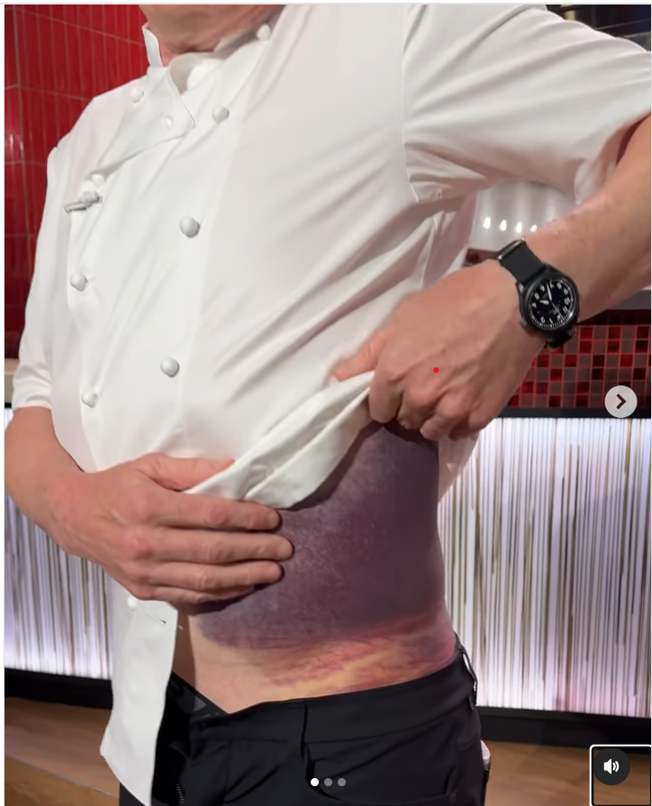 Photo of Gordon Ramsay with a terrible bruise.