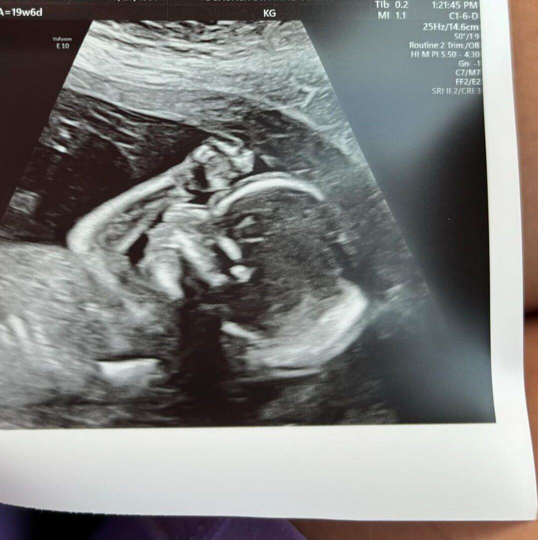 Sonogram Gypsy Rose Blanchard