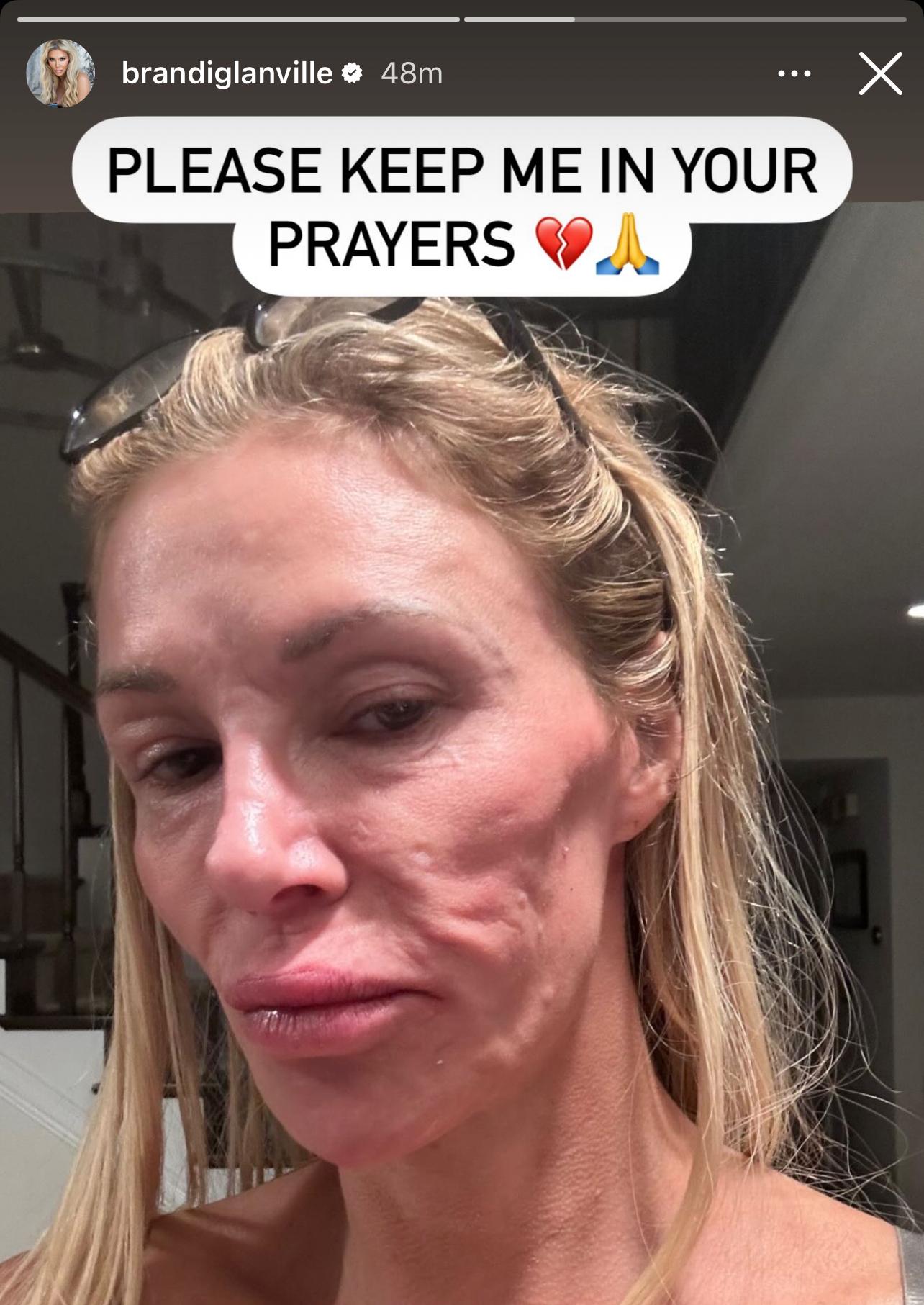 Brandi Glanville with a swollen face