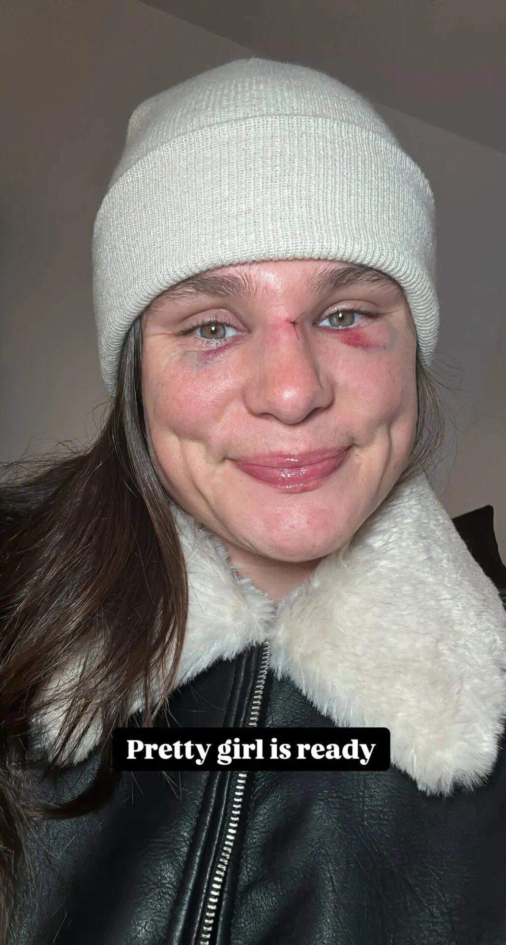 Ilona Maher shows off broken nose