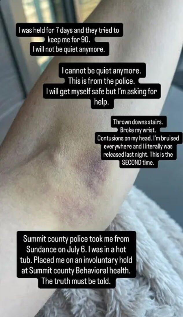 Kelley Wolf showing bruised arm