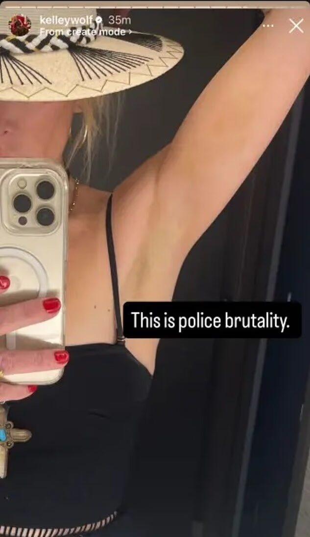 Kelley Wolf showing bruised arm