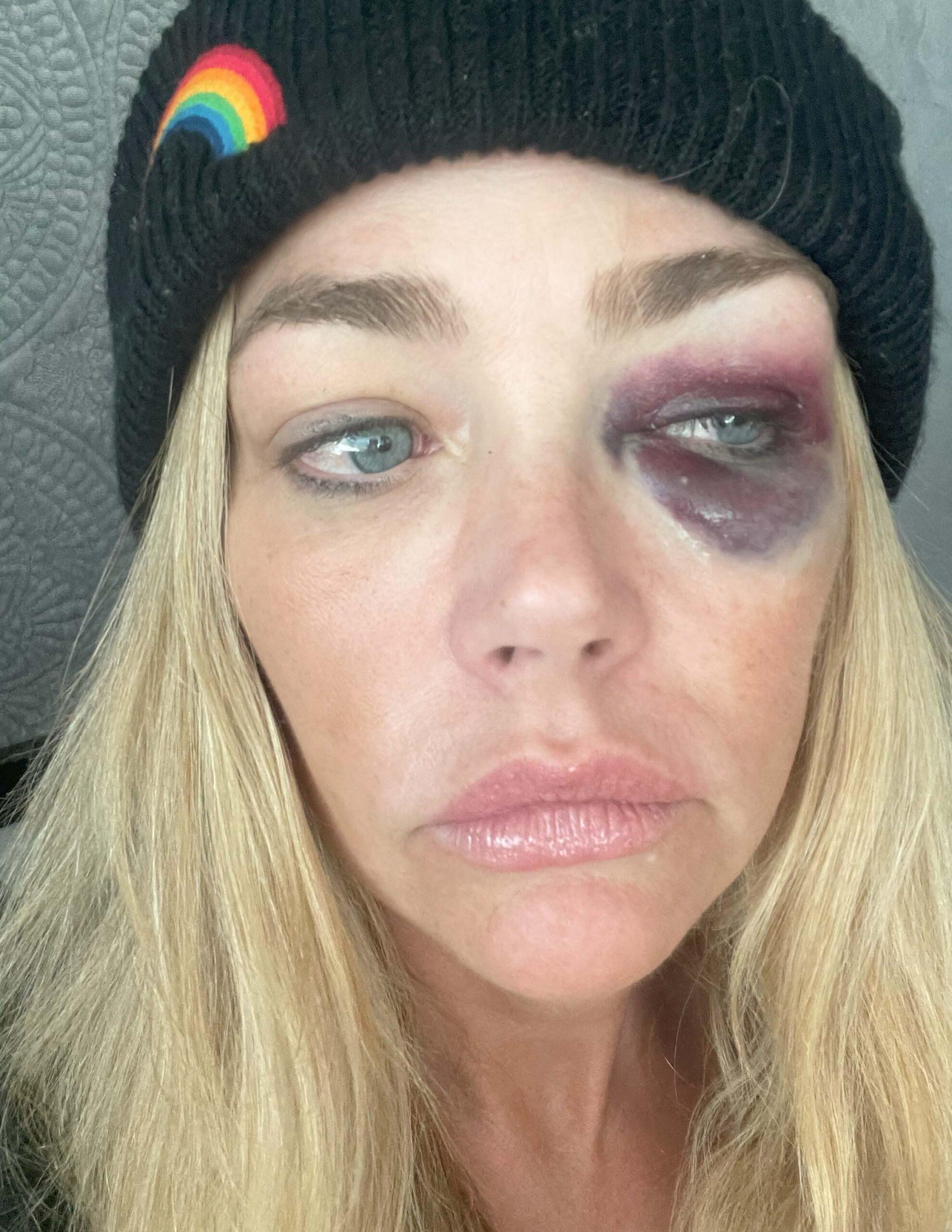 Dennis Richards anuncia fotos de lesões oculares desagradáveis ​​no pedido de restrição de violência doméstica entre uma divisão amarga de Aaron Fippers.