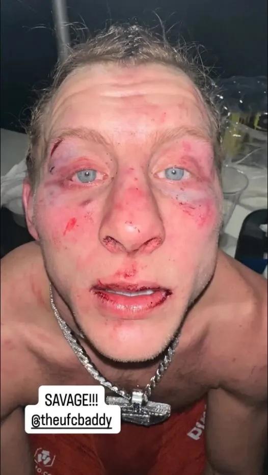 Paddy Pimblett beat up after the UFC fight