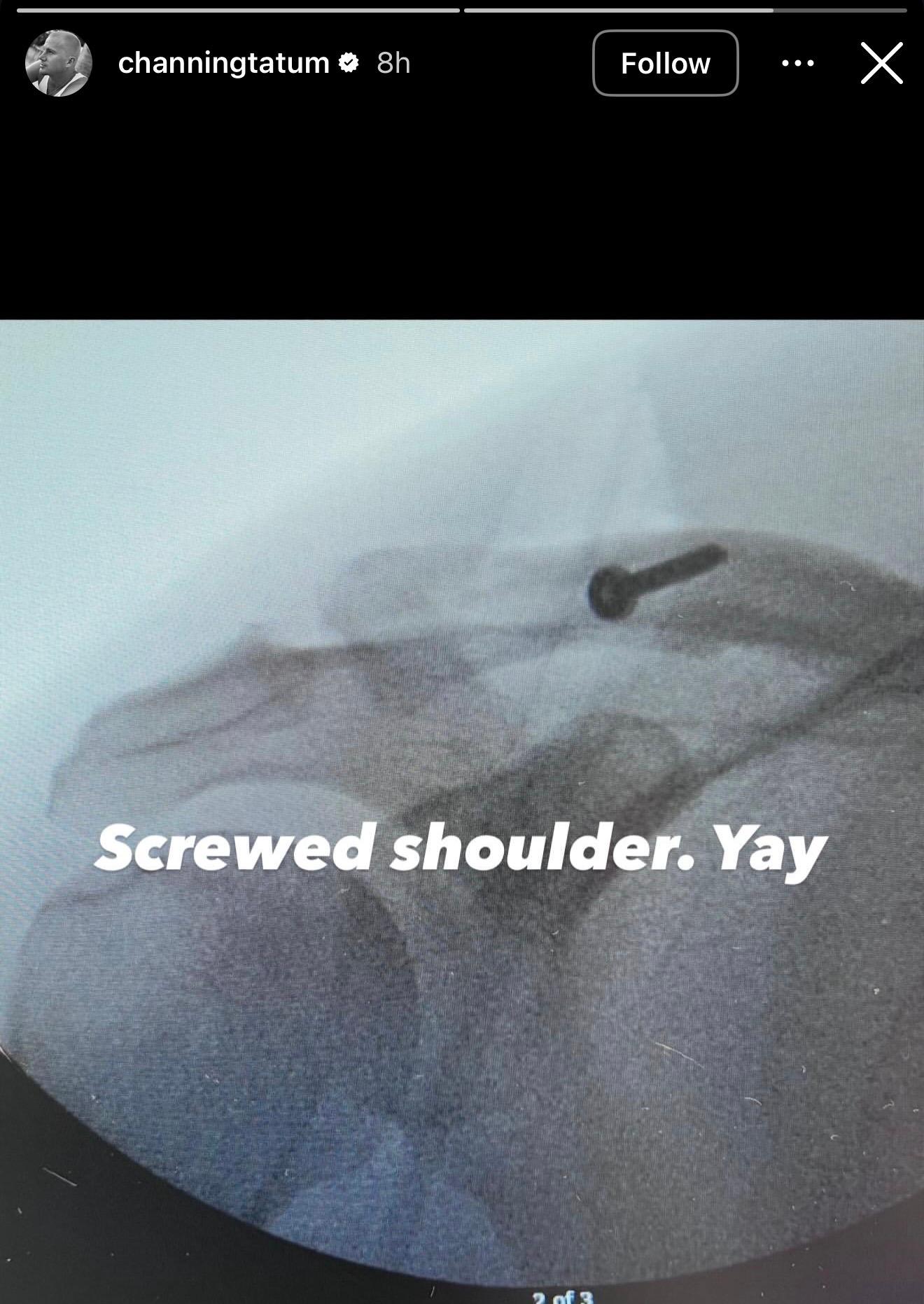 Channing Tatum reveals shoulder injury