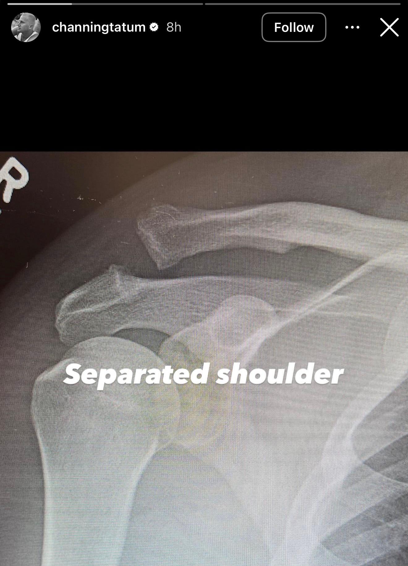 Channing Tatum reveals shoulder injury