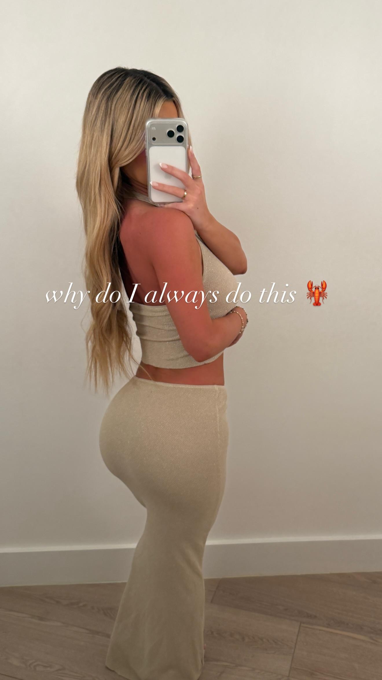 Emily Elizabeth mostra queimadura solar