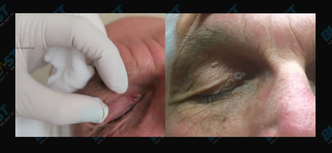 Dr Pimple Popper Huge Blackhead Gives Patient A Third Eye!